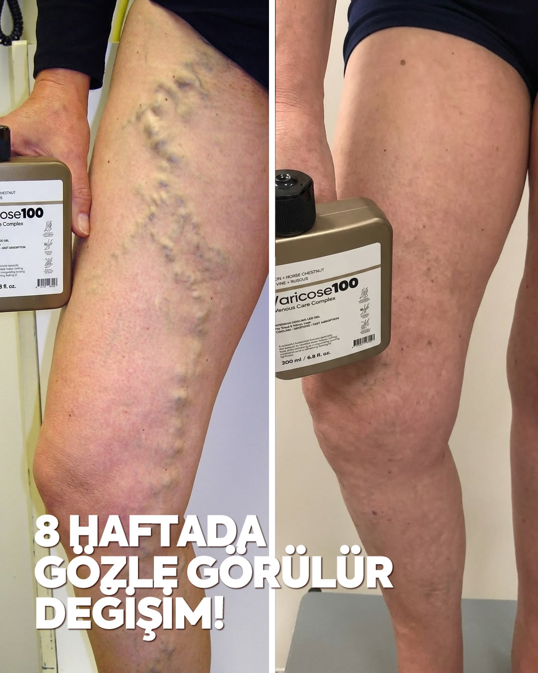 Varicose 100 - Almanya'dan İthal