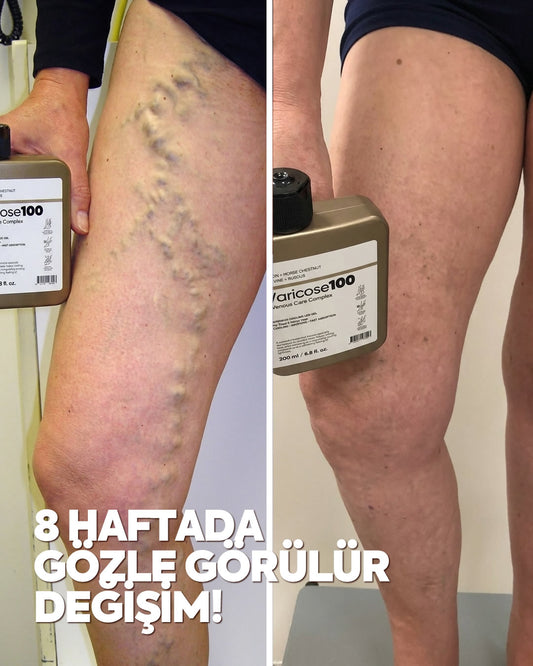 Varicose 100 - Almanya'dan İthal